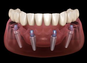 Denti fissi in 24 a Imperia