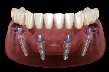 Denti fissi in 24 a Imperia